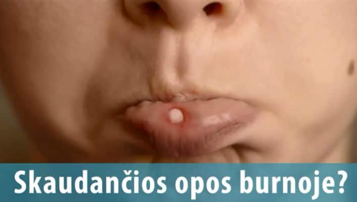 Asmens, kurio apatinės lūpos viduje matoma žaizdelė, vaizdas iš arti. Po paveikslu yra tekstas lietuvių kalba „Skaudančios opos burnoje? o tai reiškia "skausmingos opos burnoje?" Tai pabrėžia, kaip svarbu išlaikyti sveiką šypseną. - Pasveik.lt Asmens, kurio apatinės lūpos viduje matoma žaizdelė, vaizdas iš arti. Po paveikslu yra tekstas lietuvių kalba „Skaudančios opos burnoje? o tai reiškia "skausmingos opos burnoje?" Tai pabrėžia, kaip svarbu išlaikyti sveiką šypseną.